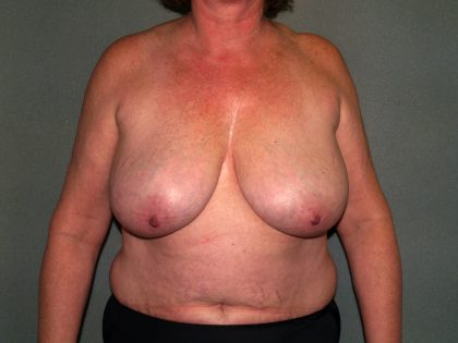 Breast Reconstruction Before & After Patient #1739