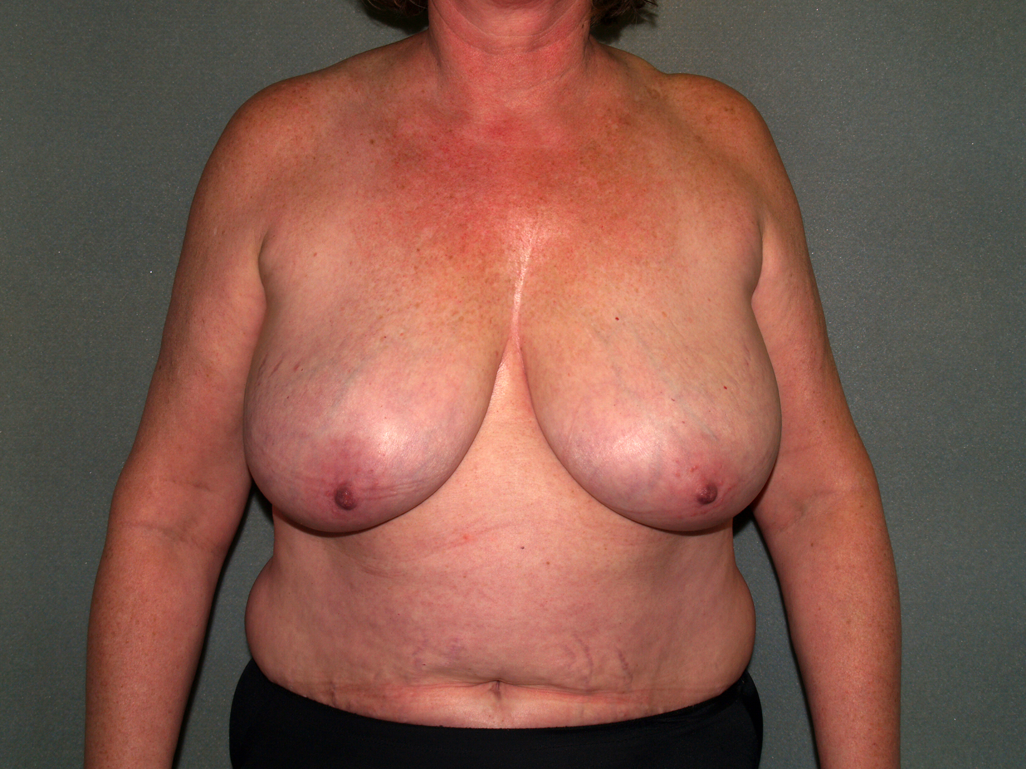 Breast Reconstruction Before & After Patient #1739