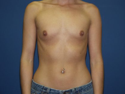 Breast Augmentation Before & After Patient #2552