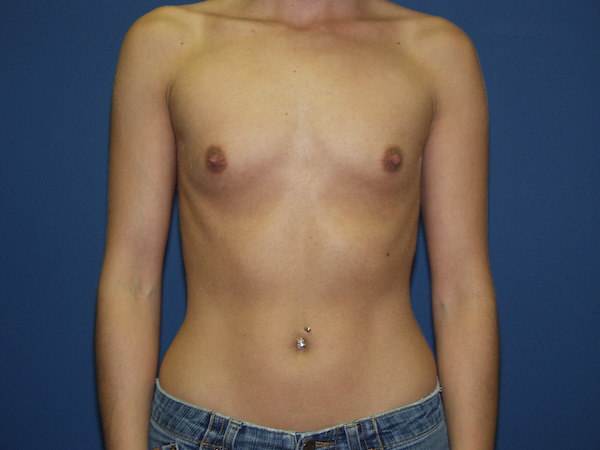 Breast Augmentation Before & After Patient #2552
