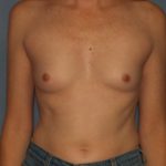 Breast Augmentation Before & After Patient #2626