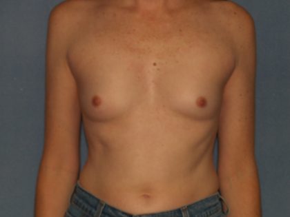 Breast Augmentation Before & After Patient #2626