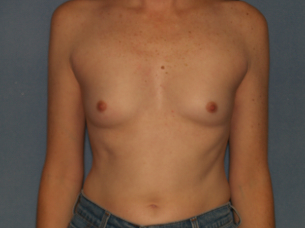 Breast Augmentation Before & After Patient #2626