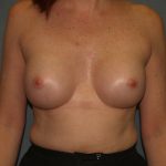 Breast Augmentation Before & After Patient #2626