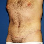 Circumferential Tummy Tuck Before & After Patient #875