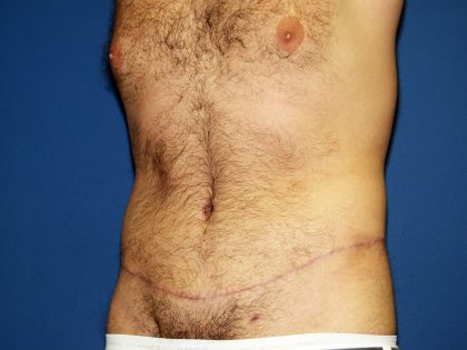 Circumferential Tummy Tuck Before & After Patient #875