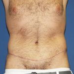 Circumferential Tummy Tuck Before & After Patient #875