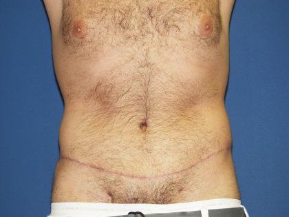 Circumferential Tummy Tuck Before & After Patient #875