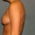 Breast Reduction Before & After Patient #3101