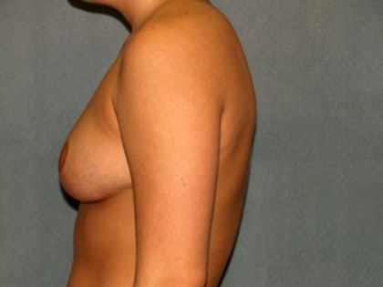 Breast Reduction Before & After Patient #3101