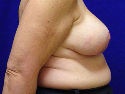 Breast Reduction Before & After Patient #3517