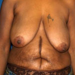 Breast Reduction Before & After Patient #3255