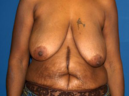 Breast Reduction Before & After Patient #3255