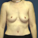 Breast Augmentation Before & After Patient #2885