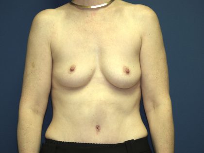 Breast Augmentation Before & After Patient #2885