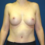 Breast Augmentation Before & After Patient #2885