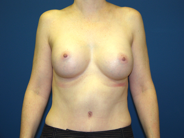 Breast Augmentation Before & After Patient #2885