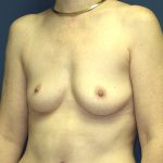 Breast Augmentation Before & After Patient #2885
