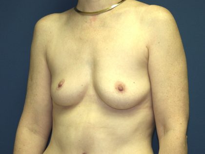 Breast Augmentation Before & After Patient #2885