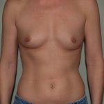 Breast Augmentation Before & After Patient #3053