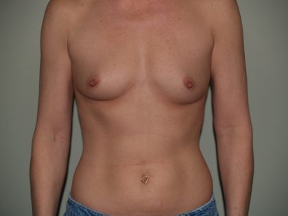 Breast Augmentation Before & After Patient #3053