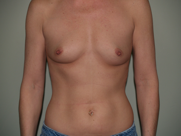 Breast Augmentation Before & After Patient #3053