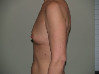 Breast Augmentation Before & After Patient #3053