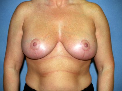 Breast Lift with Implant Before & After Patient #1573