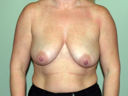 Breast Lift with Implant Before & After Patient #1573