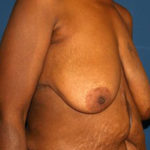 Breast Reduction Before & After Patient #3255