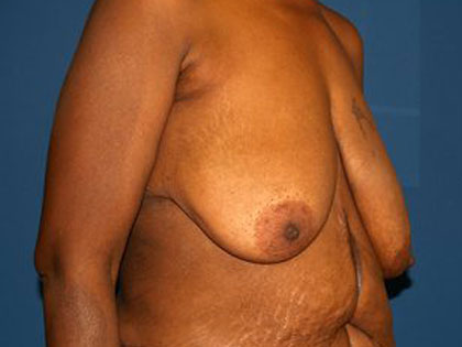 Breast Reduction Before & After Patient #3255