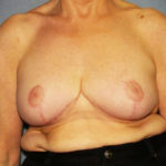 Breast Reduction Before & After Patient #3272