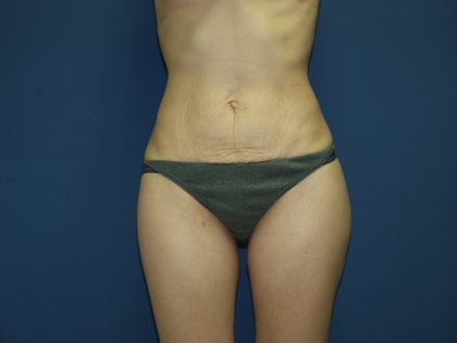 Tummy Tuck Before & After Patient #2361