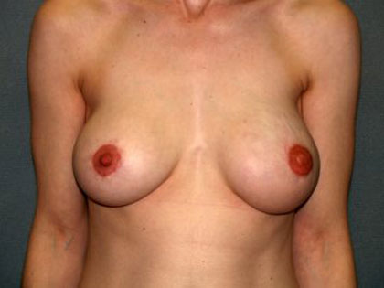 Breast Reconstruction Before & After Patient #1775