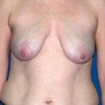 Breast Reconstruction Before & After Patient #1746