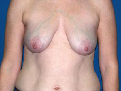 Breast Reconstruction Before & After Patient #1746