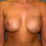 Breast Reconstruction Before & After Patient #1711