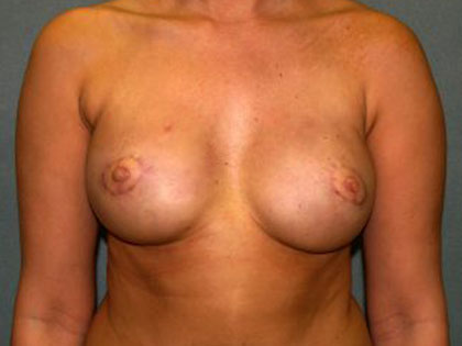 Breast Reconstruction Before & After Patient #1711