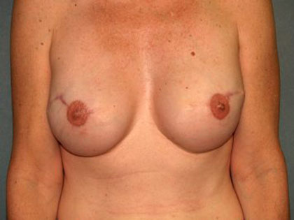 Breast Reconstruction Before & After Patient #2130