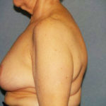 Breast Reduction Before & After Patient #3272