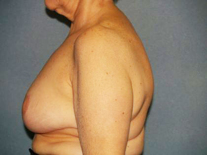 Breast Reduction Before & After Patient #3272