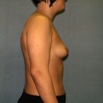 Breast Reconstruction Before & After Patient #2212