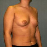 Breast Reconstruction Before & After Patient #2212