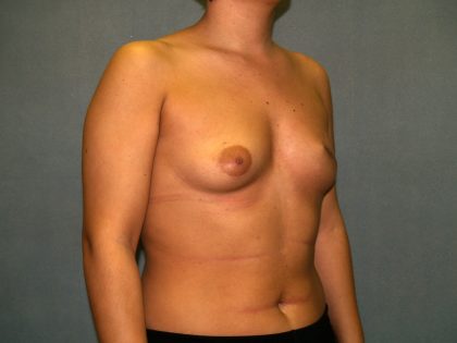 Breast Reconstruction Before & After Patient #2212