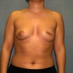 Breast Reconstruction Before & After Patient #2212