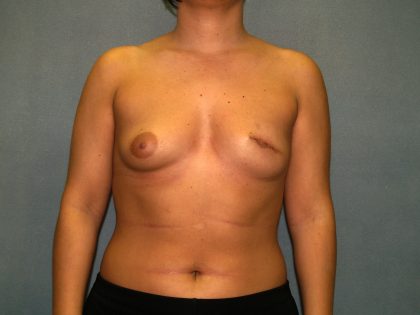 Breast Reconstruction Before & After Patient #2212