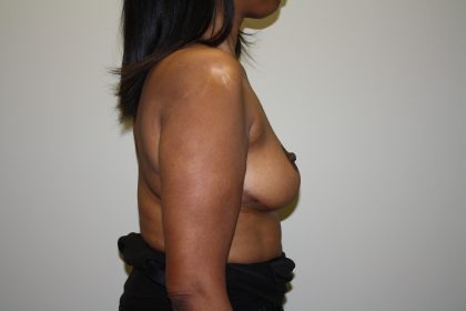 Breast Reduction Before & After Patient #3329