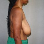 Breast Reduction Before & After Patient #3329
