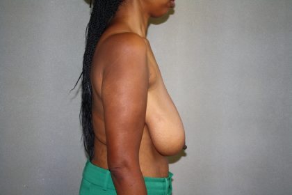 Breast Reduction Before & After Patient #3329