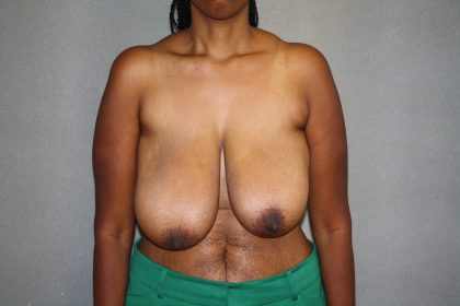 Breast Reduction Before & After Patient #3329